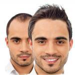 hair Transplantation de cheveux