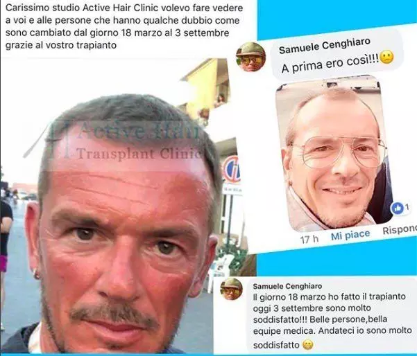 trapianto-capelli-bulbi_mini