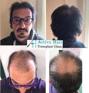 before-after-10