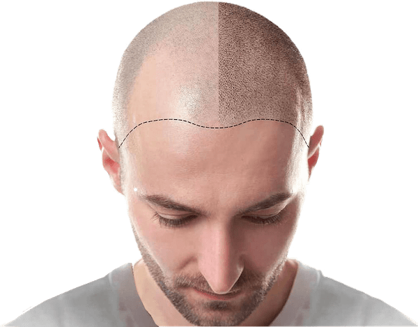 hair-min trapianto di capelli turchia